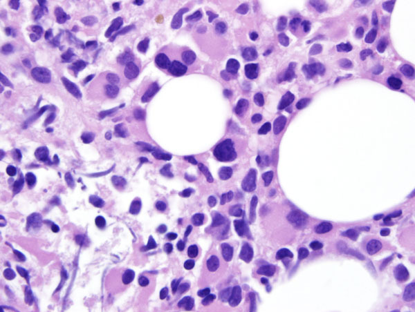 Fig 1C BMX 100x dysplastic megakaryocytes